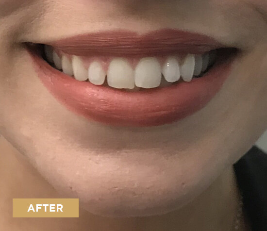 gummy smile after