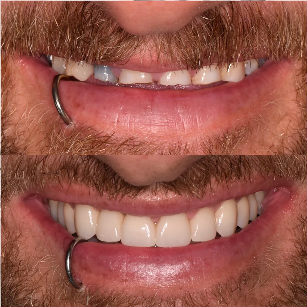 Smile Makeover Wanneroo