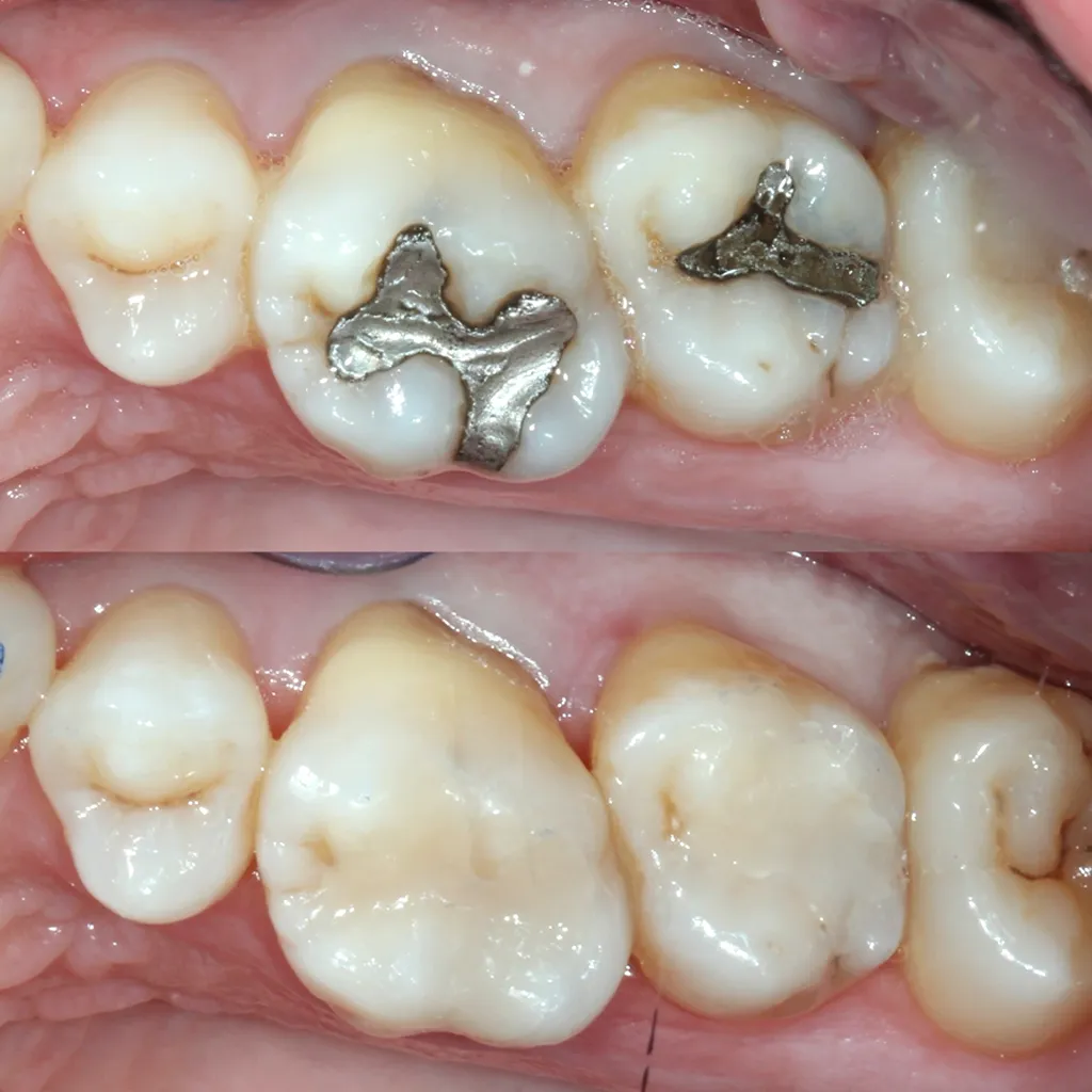 Dental Fillings Banksia Grove